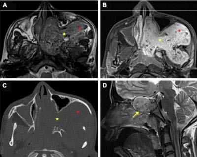 5% of all nasopharyngeal neoplasms Clinical symptoms: profuse epistaxis in young adolescent boy Arise from