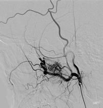 features (involvement of sphenopalatine foramen, pterygopalatine fossa) CT: broadening of fossa, foramina,