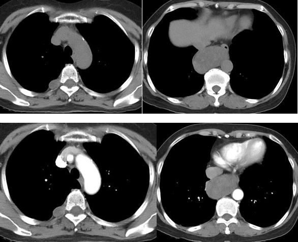 영상증례 2: 흉부 -<1부 > Tumor 09:15-09:30