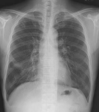 ) 증례 7 57 세남자환자로폐렴치료후에도지속되는 chest PA 이상으로내원하여흉부 CT