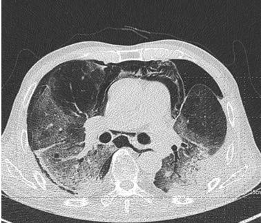 lobectomy 시행받은뒤외국병원에서면역치료받던환자임.