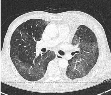 당시 nasal prong으로 5L의산소를공급받아 SpO2 97%