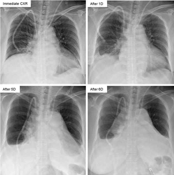 영상증례 2: 흉부 -<3부 > Infection and injury 11:15-11:30 컨퍼런스 2 좌장 : 김윤현 ( 전남대학교병원 ), 정연주 ( 부산대학교병원 ) 증례 15, 16 구현정 ( 울산의대서울아산병원 ) 증례 15.