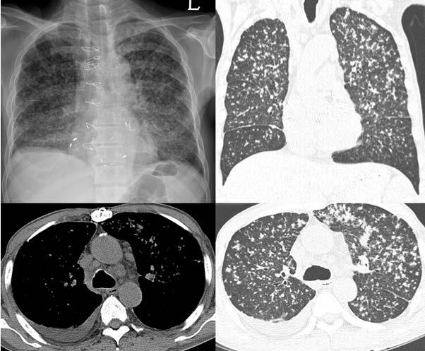 영상증례 2: 흉부 -<3부 > Infection and injury 11:30-11:45 컨퍼런스 2 좌장 : 김윤현 ( 전남대학교병원 ), 정연주 ( 부산대학교병원 ) 증례 17, 18