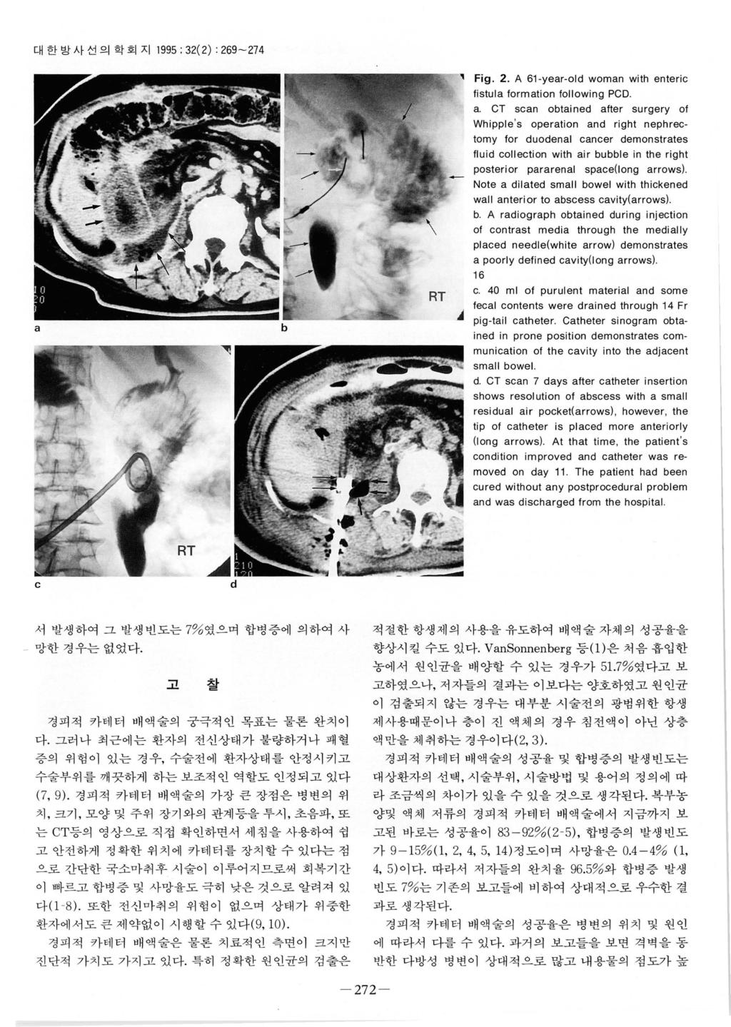 대한방사선의학호 지 1995; 32(2) : 269-274 Fig. 2. A 61-year-old woman with enteric listula lormation lollowing PCD a.