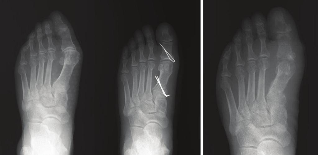 무지외반증의근위갈매기형절골술후고정방법에따른결과차이 A B Fi g u r e 1. (A) A 75 year old male had the proximal chevron osteotomy on his left foot fixed with K-wires.