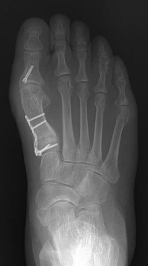 (C) Hallux valgus was corrected after proximal chevron osteotomy fixed