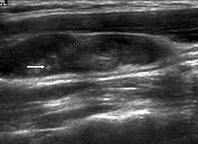 44 대한내분비외과학회지 : 제 8 권제 1 호 2008 Fig. 1. Sonographic findings of thyroid DSPC.