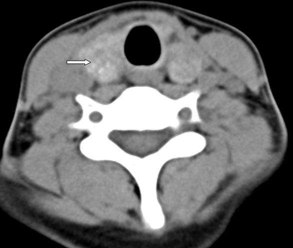 김흥철외 : 갑상샘의미만성경화아형유두상암의 1 예보고 : 초음파와컴퓨터단층촬영영상 45 Fig. 2. Axial CT images of thyroid DSPC.