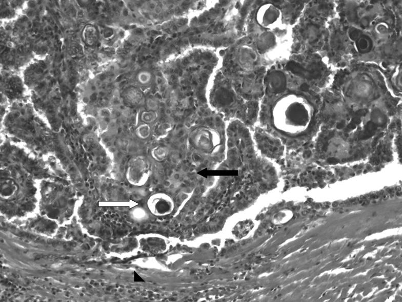 46 대한내분비외과학회지 : 제 8 권제 1 호 2008 Fig. 4. Histopathologic appearance of the DSPC (H&E stain, 200). Numerous psammoma bodies (white arrow) with neoplastic cells are noted (black arrow).