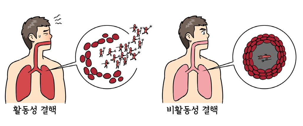 02 11 활동성결핵이란무엇인가요? Chapter 2 결핵의결핵개요진단 흉부방사선사진에서관찰되는결핵병변은활동성결핵과비활동성결핵으로나눌수있습니다.