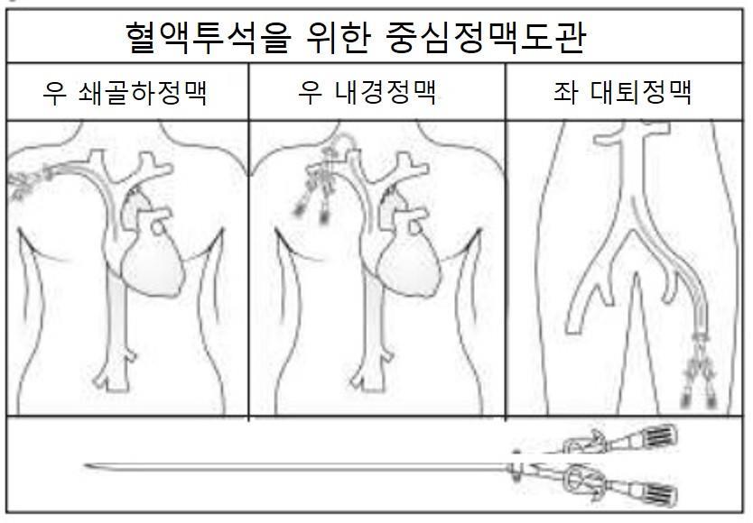 콩팥을건강하게 투석막은특화된여과기로환자의혈액이여과기를통과하면서노폐 물과수분이제거됩니다. 투석막은투석기에의해서공급되는투석 액의도움으로혈액을정화시킵니다. 투석기계가투석막에서정화된혈액을다시체내로보냅니다. 혈액투석은대부분일주일에 3회시행되며한번에 4시간정도소요 됩니다.