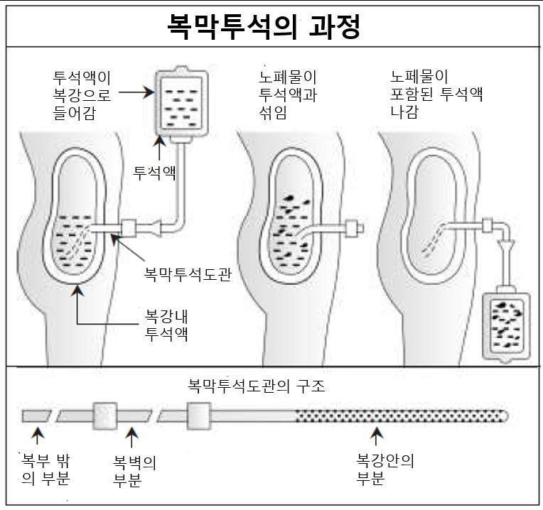 제 13 장. 투석 주입 : 무균적인투석백에서투석액이복막투석도관과연결된관을통해서중력에의해서복강안으로들어갑니다. 보통 2 L의투석액이주입됩니다. 머무름 : 이시기에는복막투석액이복강안에머무릅니다.