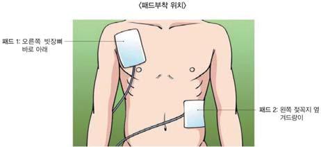 즐거운현장체험학습안전매뉴얼 심폐소생술주의사항 - 숨을불어넣는중에도가슴이오르락내리락하지않으면이는숨구멍이막혀있다는증거다. 이때는환자의아래턱을앞으로당겨서다시시도하여야한다. - 유아나영아인경우에는머리를어른에서와같이심하게뒤로젖히지말아야하며, 코와입을동시에사용해서공기를불어넣어준다.