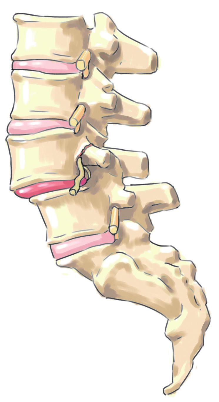 척추관절의연결고리가약해지므로허리가앞으로밀리면서신경이나관절을자극하여허리가아프면서다리까지고통이퍼져갈수있습니다.