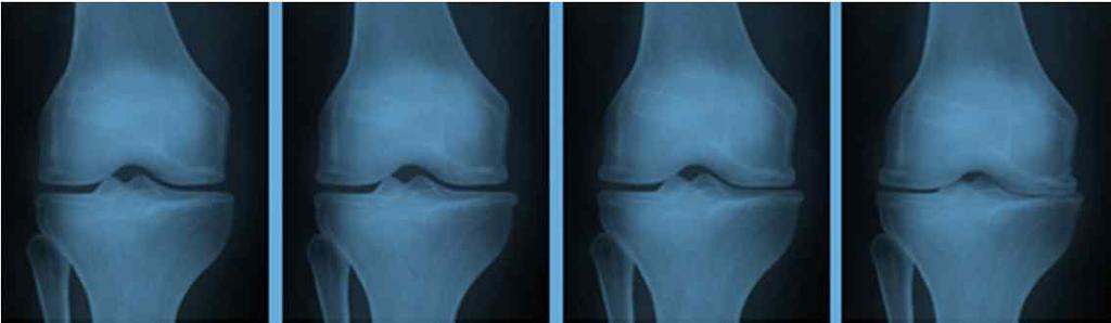 04 HL-JOINT 100 차별화된원천기술력 - 골관절염시장현황 현재시장에서골관절염에대한적절한치료방법의부재 :