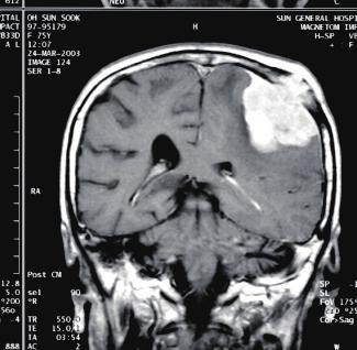 SAMSUNG MEDICAL CENTER 질환에대한이해 5 목차 01 뇌종양이란? 질환에대한이해 01 뇌종양이란?
