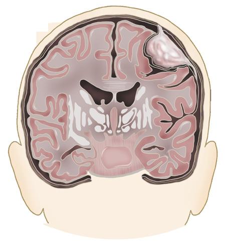 8 뇌종양질환에대한이해 SAMSUNG MEDICAL CENTER 질환에대한이해 9 (3) 상의세포종 (Ependymoma) 상의세포종은성인에서는두개강내교종중 5% 정도발생하고소아에서는 10% 정도로알려져있습니다. 5~34세사이에흔하게발생하고, 약 85% 는양성입니다. 뇌관모양의공간세포에서기원하는이종양은뇌의아래쪽뒤쪽에위치합니다.