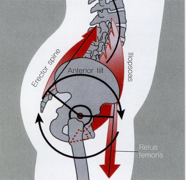 요추전만증가 : 골반의전방경사증가 - 고관절굴곡근들과척추기립근이짝힘으로작용하여골반의전방경사유발 http://i.imgur.com/rsuha.