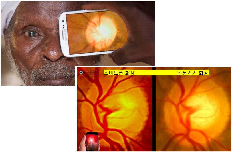 최근에는개인들의창의성만있으면얼마든지이것들을조합하여지역문제해결형융합기술로서현지에저렴하게보급할수있는길들이열리고있다. < 그림 1> Peek Retina 기술을이용한안구질환환자의원격진료 예를들면 Peek Retina 41) 라는기술은 Android 기반의중고스마트폰만있으면그속에내장된카메라의우수한기능을이용한것이다.