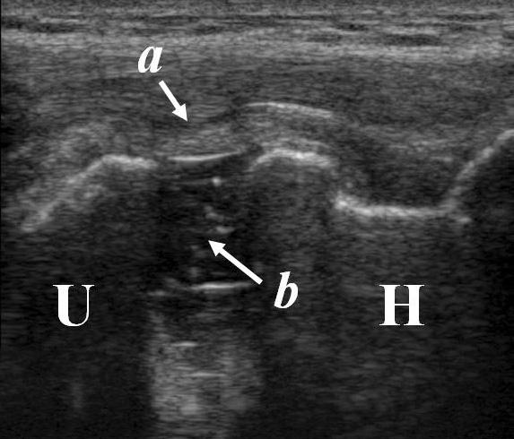 TH Hwang, et al. Gravity Valgus Stress Ultrasonographic Assessment of Ulnar Collateral Ligament Injury among Baseball Players Fig. 2.