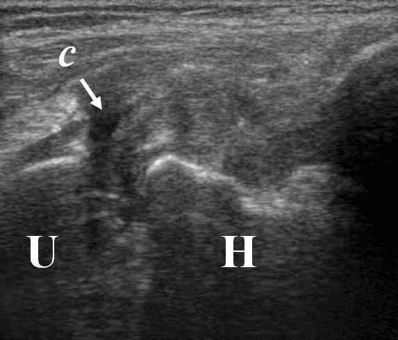 Long axis views show (A) thickening and wavy contour of UCL (a) and increased joint effusion (b), (B) focal hypoechoic focus (c) corresponding to UCL tear, (C) small
