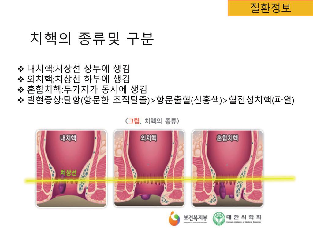 제 13 회팜엑스포및약사공론 내치핵은 4단계구분되며출혈이있으나탈항이없는상태 (1단계), 변볼때탈항이되나곧다시들어가는상태 (2단계), 변볼때탈항이되어배변후손으로밀어넣어야들어가는상태 (3단계),