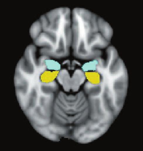 ICC 측정모형은혼합이 원배치 (two-way mixed model) 로설정하고, 유형은일치 (consistency) 로구성하여, 4 개의 MRI 장치는고정된변수 (fixed factor) 로지정하고대상자는확률적으로 (randomly) 선택되는변수로적용하여신뢰도를계산하였다.