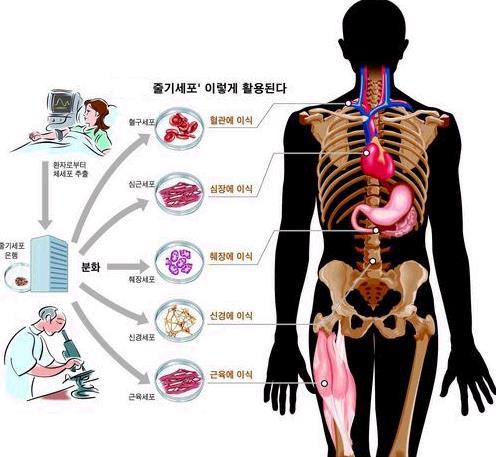 한국 - 줄기세포제조및치료