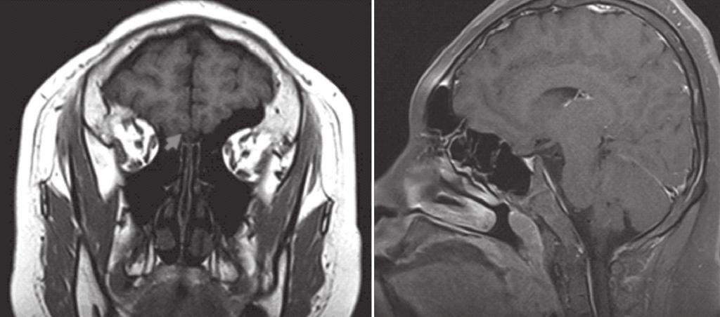 144 Hyun S, et al. Fig. 4. Coronal section of brain MRI of the patient shows bilateral absence of both olfactory bulb. But, olfactory sulcus is intact (arrow).