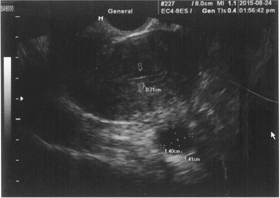A : Endometrium measuring approximately 0.53 cm (2015.07.