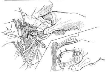 Transoral, Visor Flap and Lateral Pharyngotomy Approach Fig. 3. Lateral pharyngotomy. 상, 내측에서상후두신경을찾아미주신경의기시부까지박리한다. 설골에부착된근육들을설골에근접시켜박리하여시야를충분히확보하고위로설하신경, 아래로상후두신경 사이에인두절개를가한다.
