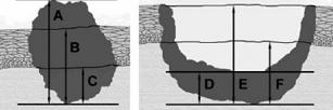 노영수 Fig. 1. Methods of measuring tumor thickness.