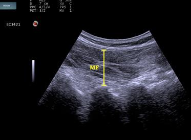 EOA; external oblique abdominis IOA; internal oblique abdominis TrA; transverse abdominis MF; multifidus 참여하기전실험에관한모든사항을상세히전달하였다.