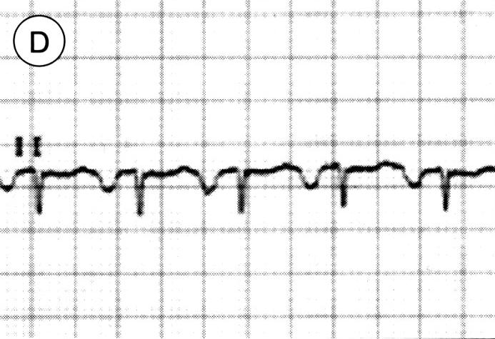 Anormal-appearing T wave pattern patient 1, Bbroad-based T wave pattern patient 5, Clow-amplitude