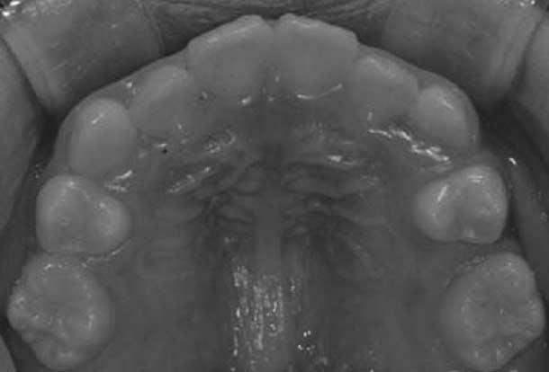 Occlusal view at 3.