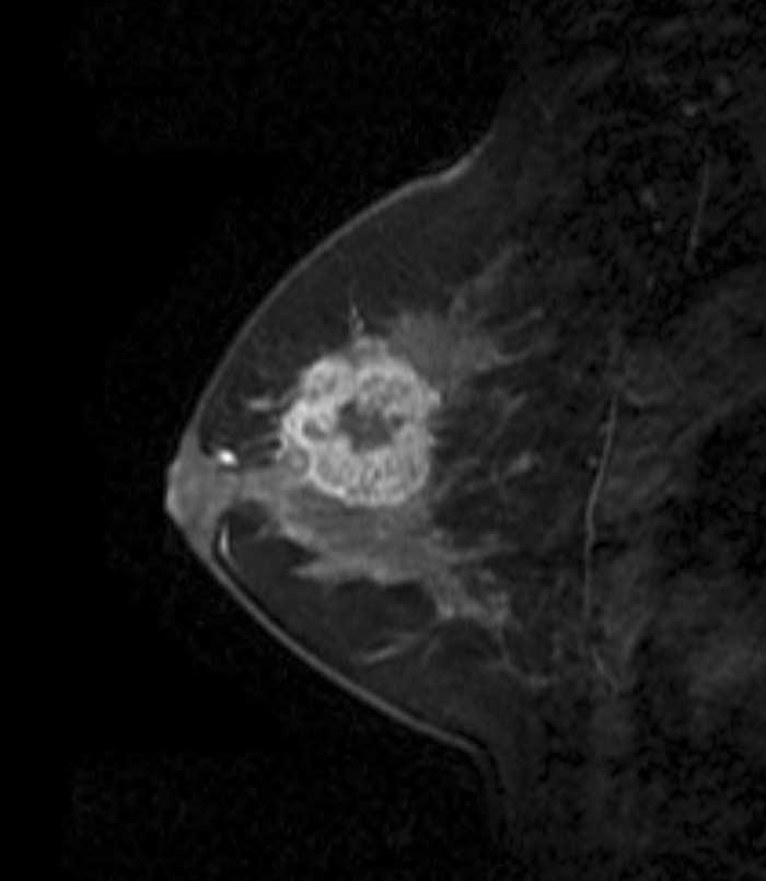 MRI Findings of Triple Negative Breast Cancer Fig. 1. MRI finding for triple negative breast cancer in 42 year-old woman.