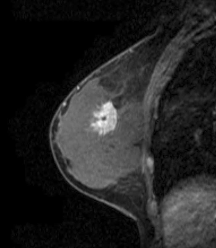 MRI finding for non-triple negative breast cancer in 46 year-old woman.