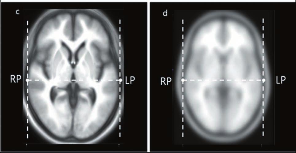 김민지외 만일변화가있으면다시처음부터모든과정을되풀이하였다 (24). 뇌구조영상표준판 (brain template) 생성 VBM5를이용하여얻은모든대상의삼차원T1강조영상과분할된조직맵 ( 회백질, 백질, 뇌척수액 ) 의뇌표준판을만들기위해 SPM5프로그램의 TOM (Template-O-Matic) 소프트웨어를사용하였다 (25).