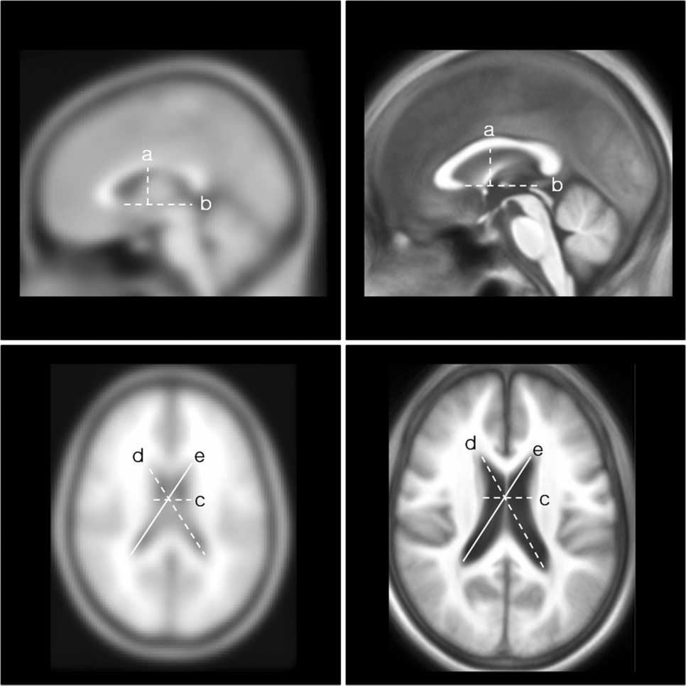 Table 2. Charateristics of the Two Standard Brain Templates 정상노인및경도인지장애및알츠하이머성치매환자에서의한국인뇌구조영상표준판개발 MNI152 # Template size (mm) 091 109 91 157 189 156 # Resolution (mm) 002 2 2 1 1 1 *Age effect 027.