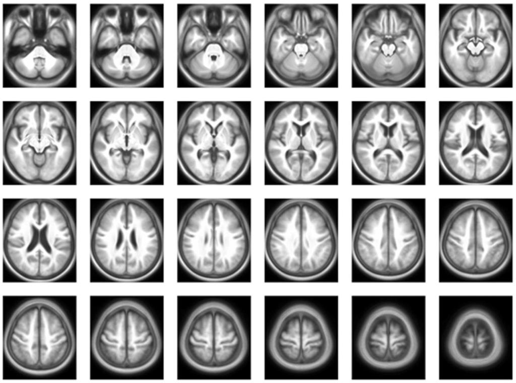 김민지외 시행하였다자기공명영상은점차고령화가가속화함에따른한국인노인및알츠하이머성치매환자의활성화된뇌영역을분석하는연구에널리기여하고있다 (27).