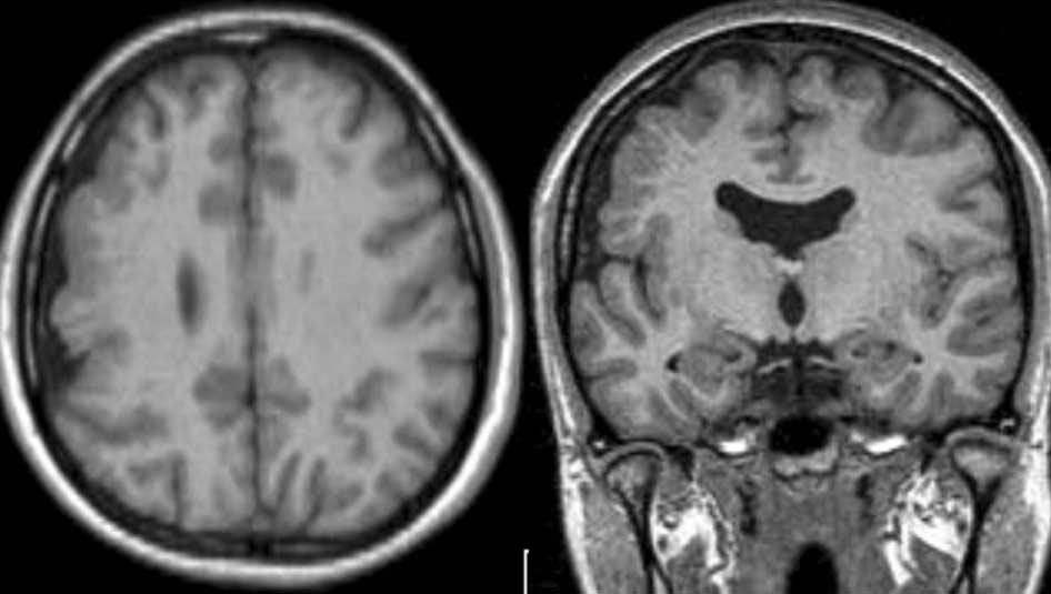 황승배외 Fig. 1. Focal cortical dysplasia. Axial and coronal MP RAGE T1 weighted images show the cortical dysplasia in right frontoparietal area(a).