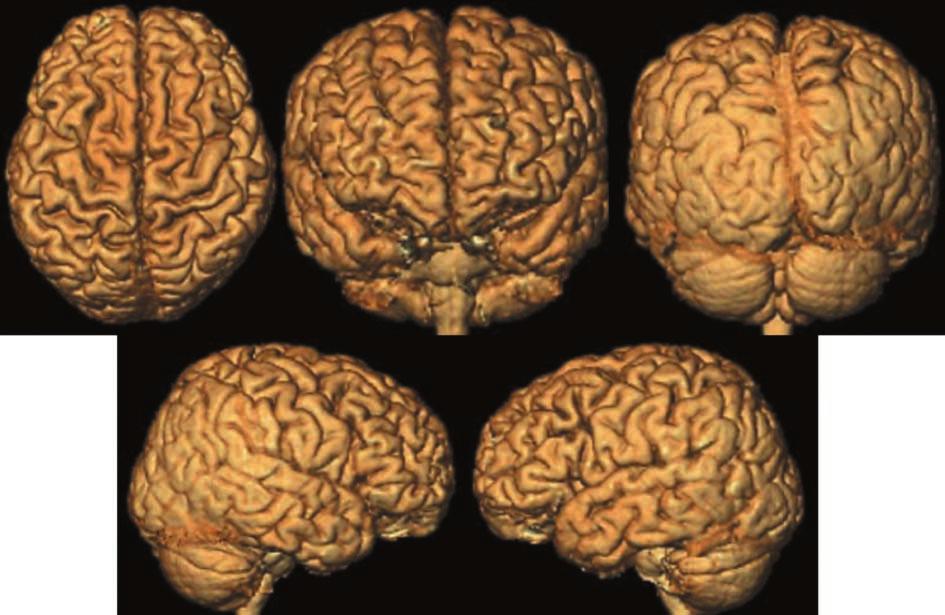 뇌피질이형성증의 3 차원뇌표면연출영상 Fig. 6. Double cortex syndrome. Areas which are clearly shown are: precentral gyrus, postcentral gyrus, superior parietal lobules, precentral sulcus, central sulcus.