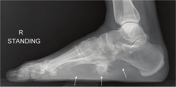 MR Imaging Findings of Parosteal Lipoma radiograph of the right foot showed an irregular bony protruding lesion from the right 5 th metatarsal base toward the plantar surface, with a surrounding