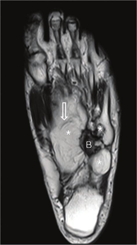 On non-enhanced coronal T1-weighted and axial T2-weighted MR images, a multi-lobulated and well-marginated high signal intensity mass with several thin low signal striations was noted in the plantar