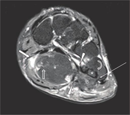 arrows) in the plantar surface of right mid foot just deep to the flexor digitorum brevis muscle.