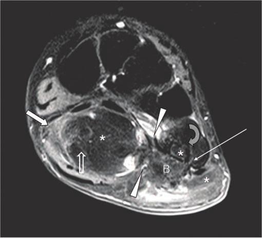 (e) Post-contrast fat-saturated coronal T1-weighted image shows minimal enhancement in the internal striations (open arrow) without demonstrable enhancing solid portion in the mass.