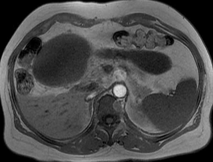 Ultrasonography and contrast enhanced computed tomography (CT) showed two homogeneous echogenic cystic masses, one 9 cm sized spherical shaped mass and the other one 11 3 cm sized tubular cystic mass