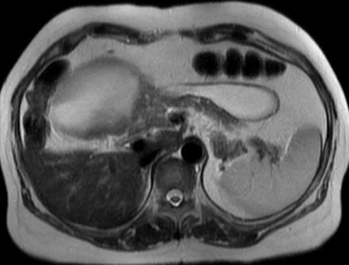 2 msec) and T2-weighted (TR/TE, 1500/89 msec) MR images showed a well circumscribed cystic mass consisting of 9 7.3 cm sized spherical and 11 3.