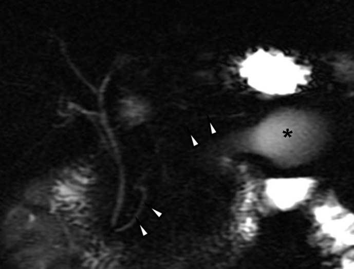 MR Images and 1 H MR Spectroscopy of Enteric Duplication Cyst of the Pancreas in an
